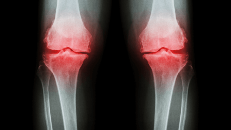 Knee Osteoarthritis