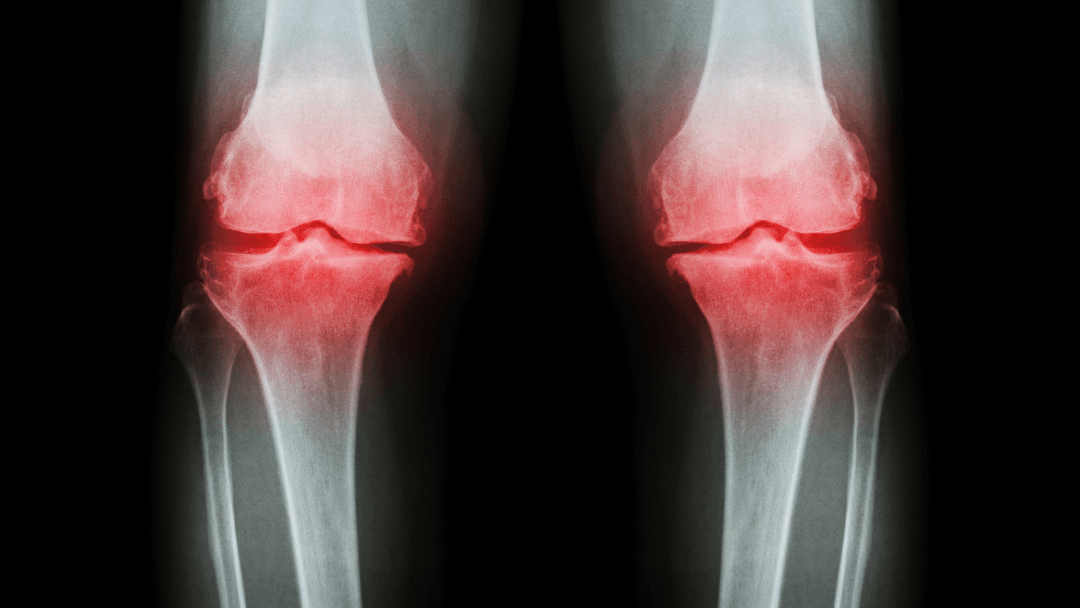 Knee Osteoarthritis