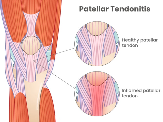 Patellar tendonitis (1)