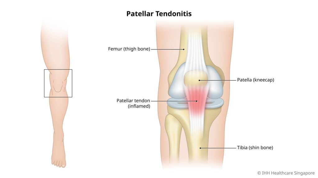 Patelarna tetiva